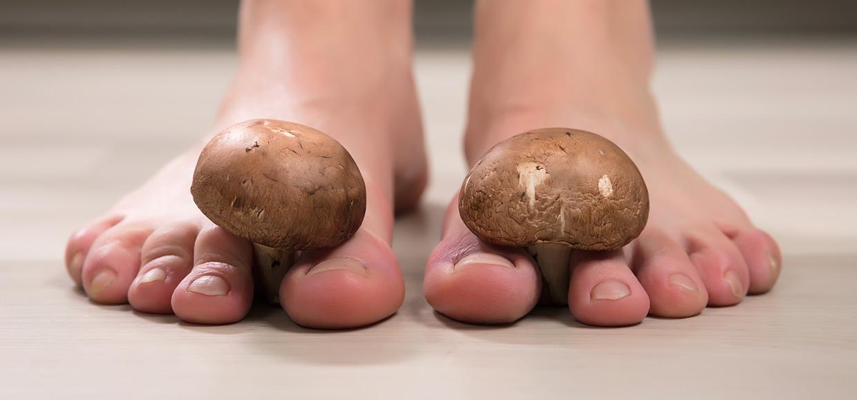 Mycose des pieds : non, ce n'est pas une fatalité !