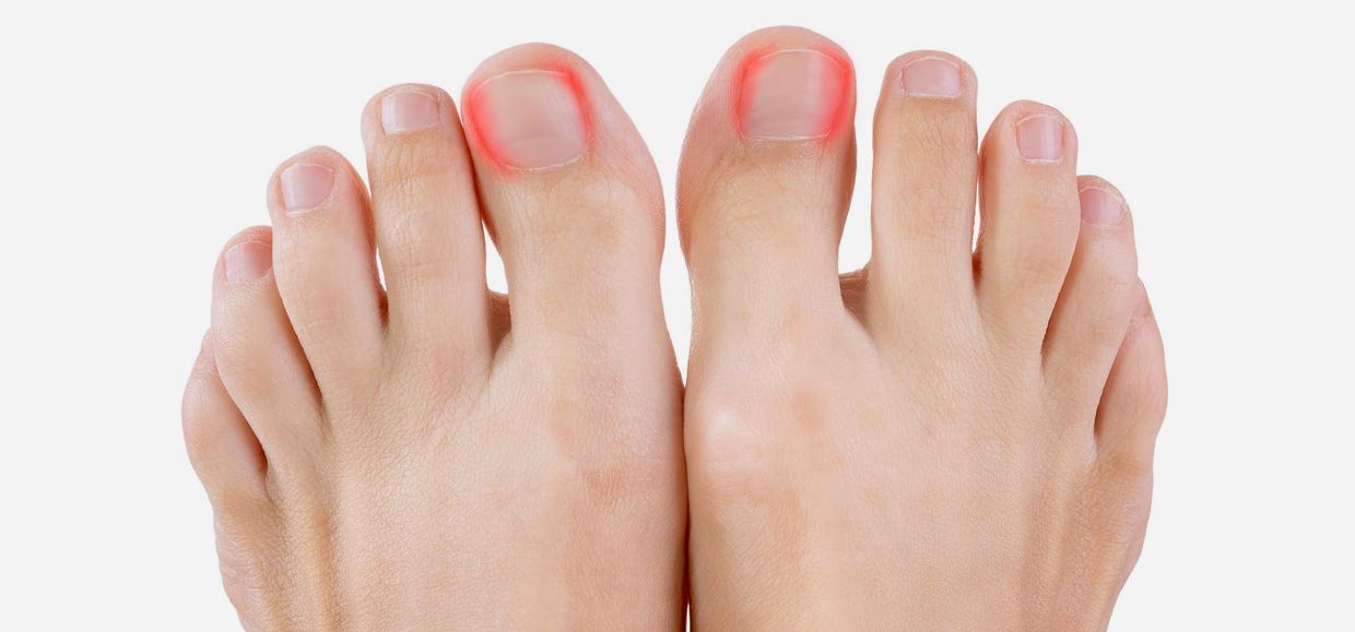 Ongle incarné au pied : le soigner et éviter la récidive | Podowell