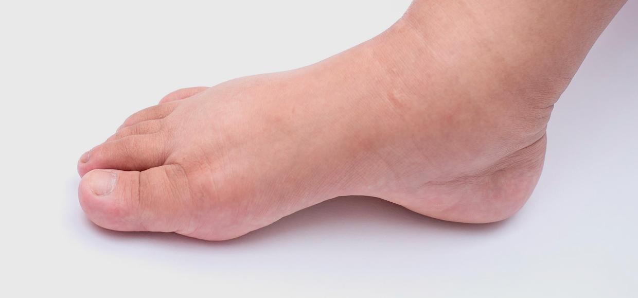 Oedème aux pieds : à chaque cause sa solution | Podowell